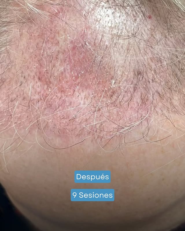 necrosis capilar injerto solución barcelona