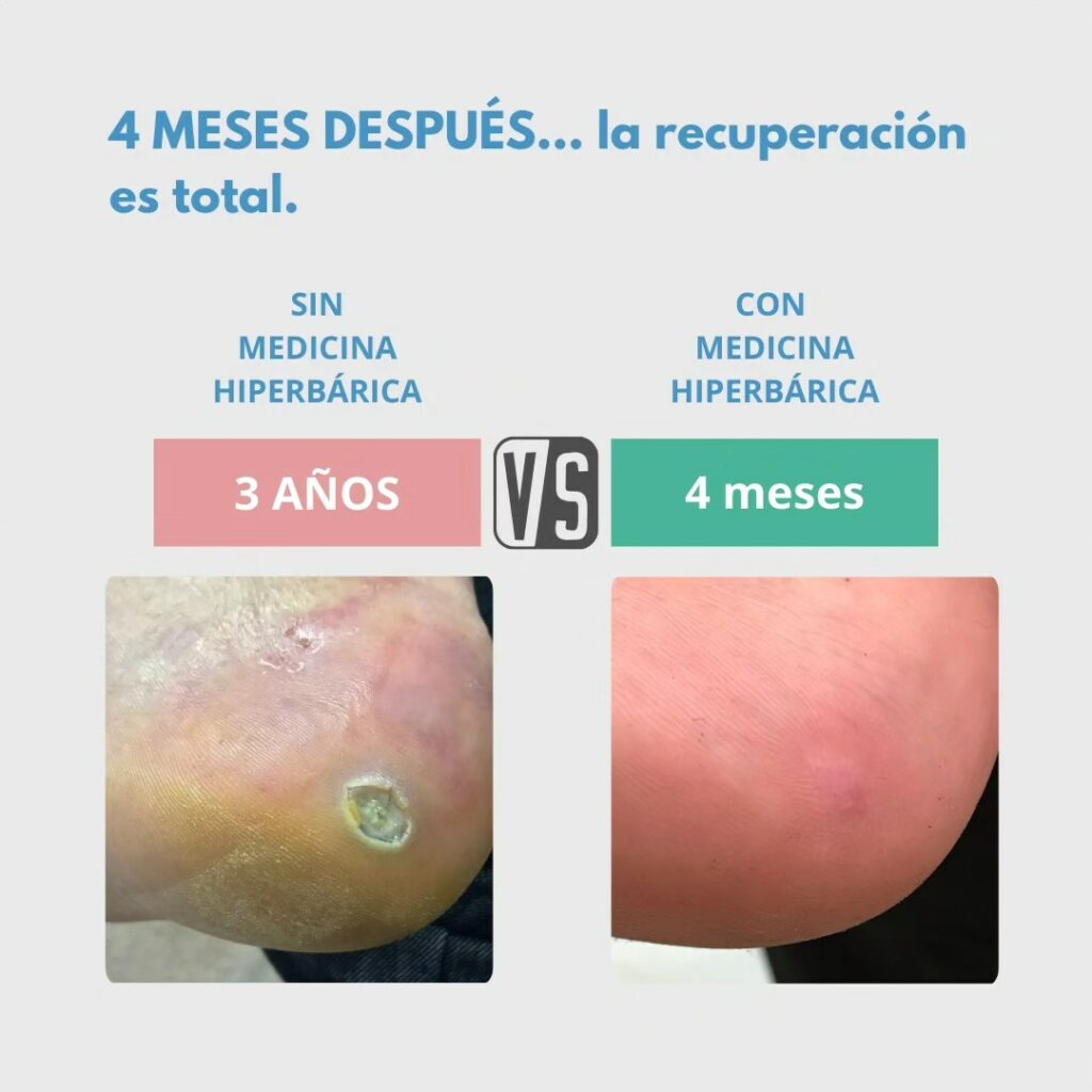 ulcera vascular barcelona